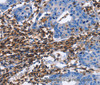 Immunohistochemistry of paraffin-embedded Human gastric cancer tissue using CD45 Polyclonal Antibody at dilution 1:40