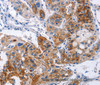 Immunohistochemistry of paraffin-embedded Human lung cancer using CD54 Polyclonal Antibody at dilution of 1:30
