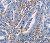 Immunohistochemistry of paraffin-embedded Human gastric cancer using CD54 Polyclonal Antibody at dilution of 1:30