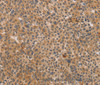 Immunohistochemistry of paraffin-embedded Human liver cancer using CDK11B Polyclonal Antibody at dilution of 1:40