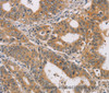 Immunohistochemistry of paraffin-embedded Human gastric cancer using CDK11B Polyclonal Antibody at dilution of 1:40
