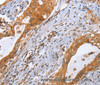 Immunohistochemistry of paraffin-embedded Human cervical cancer using CDK19 Polyclonal Antibody at dilution of 1:70