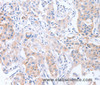 Immunohistochemistry of paraffin-embedded Human lung cancer tissue using CDCA4 Polyclonal Antibody at dilution 1:50