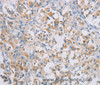 Immunohistochemistry of paraffin-embedded Human thyroid cancer tissue using CERKL Polyclonal Antibody at dilution 1:50