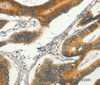 Immunohistochemistry of paraffin-embedded Human colon cancer tissue using CIB1 Polyclonal Antibody at dilution 1:30