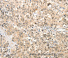 Immunohistochemistry of paraffin-embedded Human esophagus cancer tissue using TSPYL2 Polyclonal Antibody at dilution 1:30