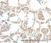 Immunohistochemistry of paraffin-embedded Human breast cancer tissue using TSPYL2 Polyclonal Antibody at dilution 1:30