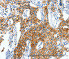 Immunohistochemistry of paraffin-embedded Human lung cancer using CKAP4 Polyclonal Antibody at dilution of 1:50