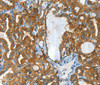 Immunohistochemistry of paraffin-embedded Human thyroid cancer tissue using CLPTM1L Polyclonal Antibody at dilution 1:60