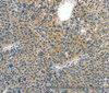 Immunohistochemistry of paraffin-embedded Human liver cancer tissue using CRLF2 Polyclonal Antibody at dilution 1:60