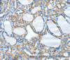 Immunohistochemistry of paraffin-embedded Human thyroid cancer tissue using HID1 Polyclonal Antibody at dilution 1:50