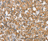 Immunohistochemistry of paraffin-embedded Human thyroid cancer tissue using CSMD1 Polyclonal Antibody at dilution 1:40