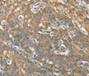 Immunohistochemistry of paraffin-embedded Human gastric cancer tissue using CSMD1 Polyclonal Antibody at dilution 1:40