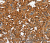 Immunohistochemistry of paraffin-embedded Human thyroid cancer using CTBP1 Polyclonal Antibody at dilution of 1:40