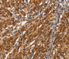 Immunohistochemistry of paraffin-embedded Human gasrtic cancer tissue using CYP2D6 Polyclonal Antibody at dilution 1:40