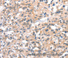 Immunohistochemistry of paraffin-embedded Human thyroid cancer tissue using CYP2D6 Polyclonal Antibody at dilution 1:40