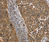 Immunohistochemistry of paraffin-embedded Human cervical cancer tissue using CSTB Polyclonal Antibody at dilution 1:30