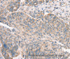 Immunohistochemistry of paraffin-embedded Human ovarian cancer using DECR1 Polyclonal Antibody at dilution of 1:50