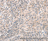 Immunohistochemistry of paraffin-embedded Human prostate cancer using DECR1 Polyclonal Antibody at dilution of 1:50
