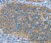 Immunohistochemistry of paraffin-embedded Human cervical cancer tissue using DTX1 Polyclonal Antibody at dilution 1:30