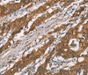 Immunohistochemistry of paraffin-embedded Human gasrtic cancer tissue using DSC2 Polyclonal Antibody at dilution 1:35