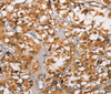 Immunohistochemistry of paraffin-embedded Human thyroid cancer tissue using DICER1 Polyclonal Antibody at dilution 1:40