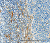 Immunohistochemistry of paraffin-embedded Human cervical cancer tissue using DIO2 Polyclonal Antibody at dilution 1:50