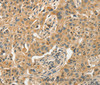 Immunohistochemistry of paraffin-embedded Human lung cancer tissue using SLC11A2 Polyclonal Antibody at dilution 1:50