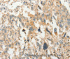 Immunohistochemistry of paraffin-embedded Human esophagus cancer tissue using SLC11A2 Polyclonal Antibody at dilution 1:50