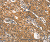 Immunohistochemistry of paraffin-embedded Human gastic cancer using DNM2 Polyclonal Antibody at dilution of 1:40