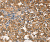 Immunohistochemistry of paraffin-embedded Human thyroid cancer tissue using AGO1 Polyclonal Antibody at dilution 1:40