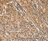 Immunohistochemistry of paraffin-embedded Human gastic cancer using AIMP1 Polyclonal Antibody at dilution of 1:40