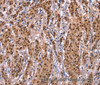 Immunohistochemistry of paraffin-embedded Human gastric cancer tissue using Ephrin A5 Polyclonal Antibody at dilution 1:40