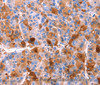 Immunohistochemistry of paraffin-embedded Human liver cancer tissue using ERN2 Polyclonal Antibody at dilution 1:40