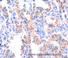 Immunohistochemistry of paraffin-embedded Human thyroid cancer tissue using ERN2 Polyclonal Antibody at dilution 1:40