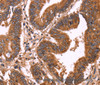 Immunohistochemistry of paraffin-embedded Human colon cancer using ERP29 Polyclonal Antibody at dilution of 1:40
