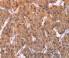 Immunohistochemistry of paraffin-embedded Human liver cancer using ERP29 Polyclonal Antibody at dilution of 1:40