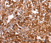 Immunohistochemistry of paraffin-embedded Human thyroid cancer tissue using ESRRB Polyclonal Antibody at dilution 1:40