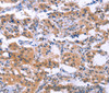 Immunohistochemistry of paraffin-embedded Human thyroid cancer using ESPL1 Polyclonal Antibody at dilution of 1:40