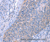 Immunohistochemistry of paraffin-embedded Human cervical cancer using ESPL1 Polyclonal Antibody at dilution of 1:40