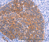 Immunohistochemistry of paraffin-embedded Human cervical cancer tissue using PTPN13 Polyclonal Antibody at dilution 1:30