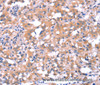 Immunohistochemistry of paraffin-embedded Human thyroid cancer tissue using FAT1 Polyclonal Antibody at dilution 1:40
