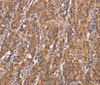 Immunohistochemistry of paraffin-embedded Human gasrtic cancer tissue using FBXO31 Polyclonal Antibody at dilution 1:40