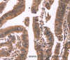 Immunohistochemistry of paraffin-embedded Human colon cancer tissue using FBXO31 Polyclonal Antibody at dilution 1:40