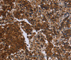 Immunohistochemistry of paraffin-embedded Human liver cancer tissue using FMN2 Polyclonal Antibody at dilution 1:30