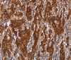 Immunohistochemistry of paraffin-embedded Human gastric cancer tissue using GCKR Polyclonal Antibody at dilution 1:50