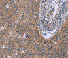 Immunohistochemistry of paraffin-embedded Human cervical cancer tissue using IL3RB Polyclonal Antibody at dilution 1:40