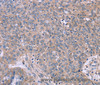 Immunohistochemistry of paraffin-embedded Human ovarian cancer tissue using IL3RB Polyclonal Antibody at dilution 1:40