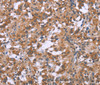 Immunohistochemistry of paraffin-embedded Human thyroid cancer tissue using GNPAT Polyclonal Antibody at dilution 1:40