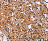 Immunohistochemistry of paraffin-embedded Human thyroid cancer tissue using GPR124 Polyclonal Antibody at dilution 1:40